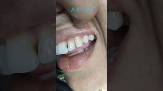 Download lagu Light Cure Composite Filling By Haider #dentalartbyhaider #filling mp3 Download lagu Light Cure Composite Filling By Haider #dentalartbyhaider #filling mp3