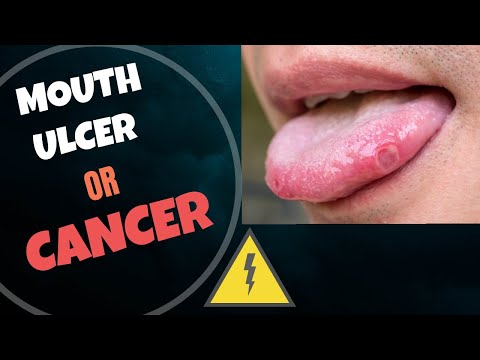 Canker sores| Features suspicious of Cancer| When is it necessary to visit a Dentist?