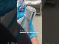 miraDry for excessive sweating 💧