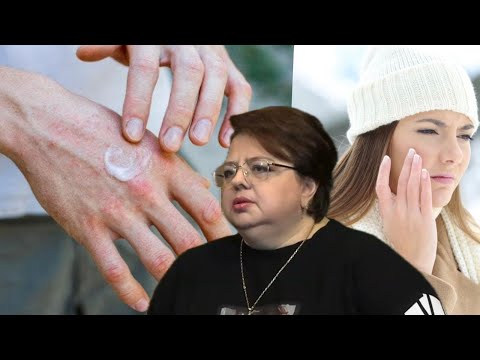 “Njerëzit me lëkurë të bardhë më të rrezikuarit në dimër”, këshillat e dermatologes