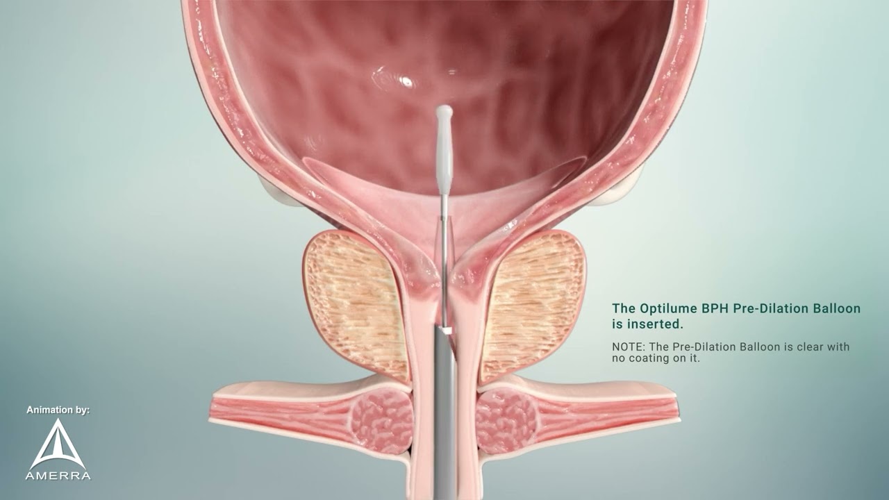 Laborie Optilume BPH - 3D Medical Animation