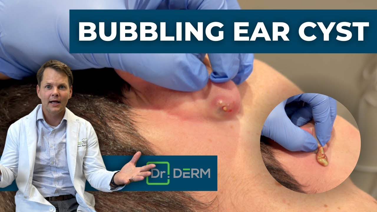Draining A Bubbling Ear Cyst! | Dr. Derm