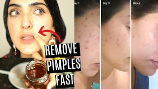 How To Get Rid Of Pimples/Acne FAST! (NATURAL + EFFECTIVE Spot Tx & Mask)~ Immy