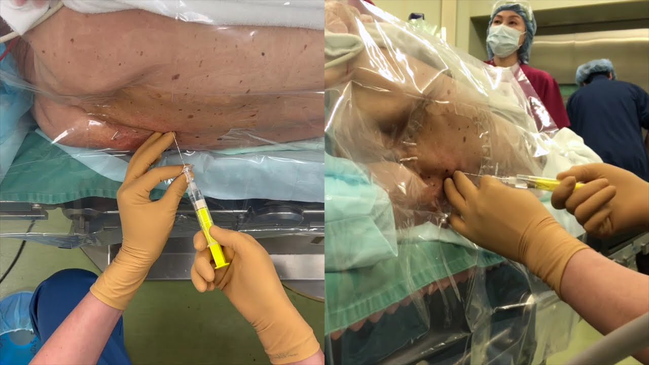 Th5/6胸部硬膜外麻酔 thoracic epidural anesthesia by Dr.EpiCal