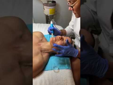 Collagen Induction Therapy Demonstration with Leslie Joy Dammer and Minx Mogul