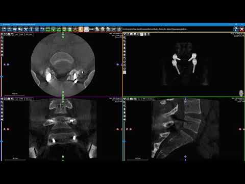NewTom 7G - Lendenwirbelsäule