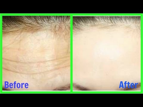 How to Remove Wrinkles from Face & Forehead naturally || Home Remedy Video