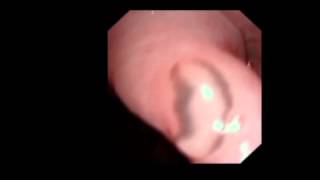 ENT TODAY   A LARYNGEAL FLUKE