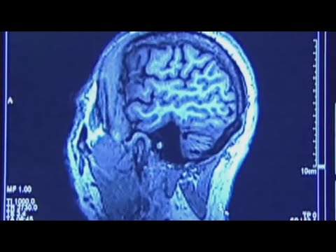 NJ Caldwell University To Host Free Alzheimer’s Conference