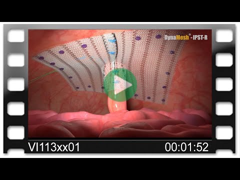 DynaMesh®-IPST-R  - Animation: Parastomal Hernia Repair
