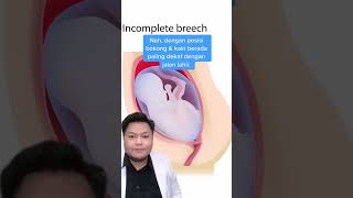 Download lagu Ini 3 Posisi Bayi Sungsang! mp3