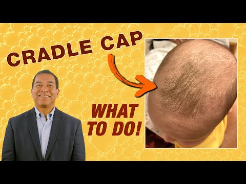 Cradle Cap: Pediatrician’s Tips for Parents (Seborrheic Dermatitis) | AAP