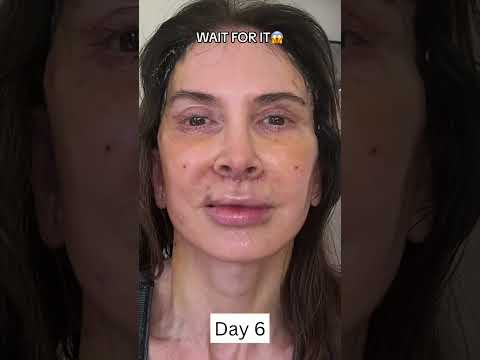INSANE 2-Week Facelift Healing and Recovery Process!