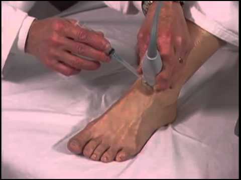 How To: Ultrasound-Guided Foot Injection Scanning Technique Video