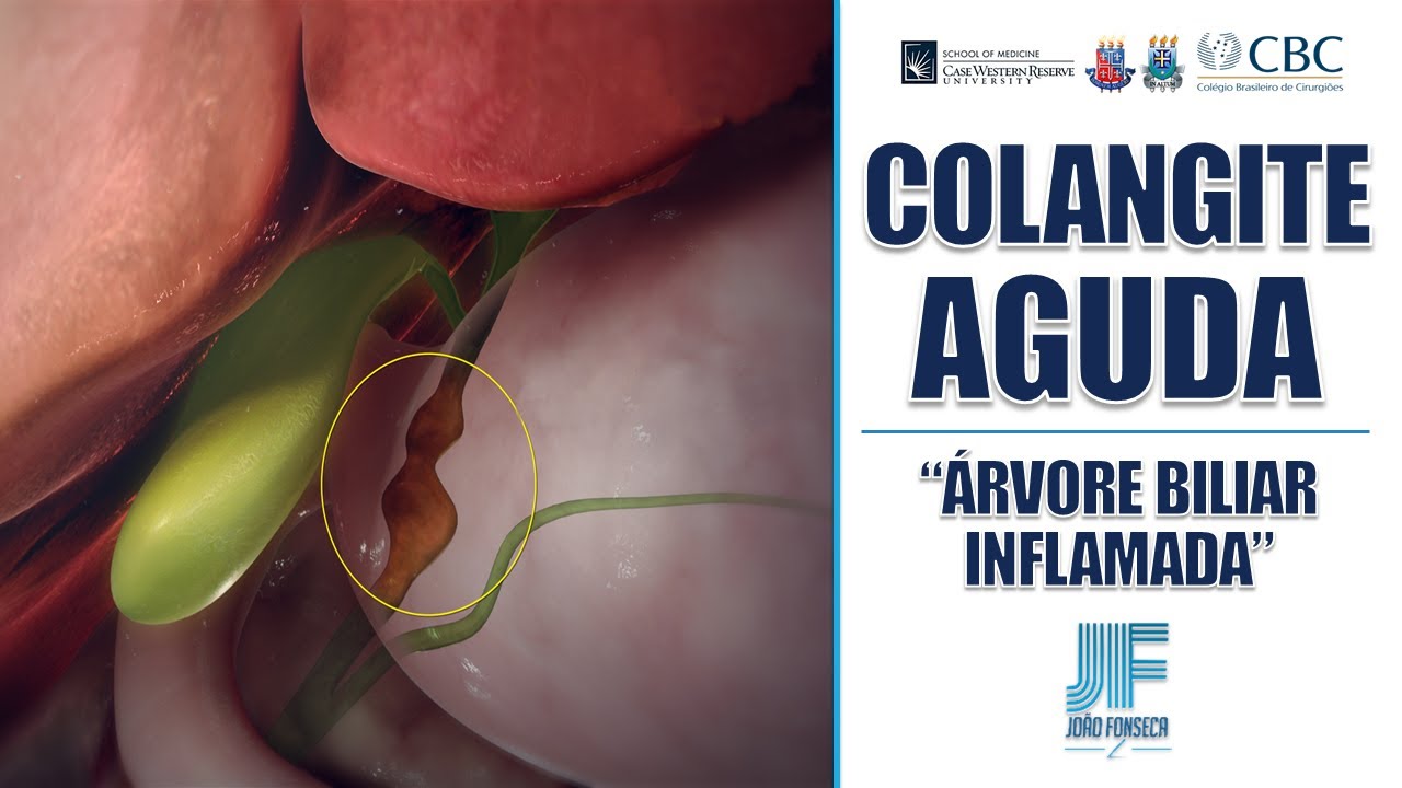 COLANGITE AGUDA 👨🏻‍⚕️🪨 Joao Fonseca (Cirurgia Geral)