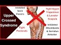 Upper Crossed Syndrome