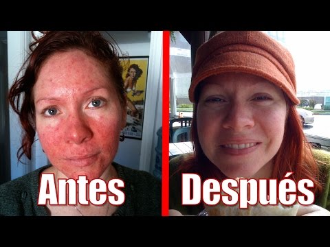 download lagu mp3 mp4 Remedios Para La Rosacea, download lagu Remedios Para La Rosacea gratis, unduh video klip Remedios Para La Rosacea