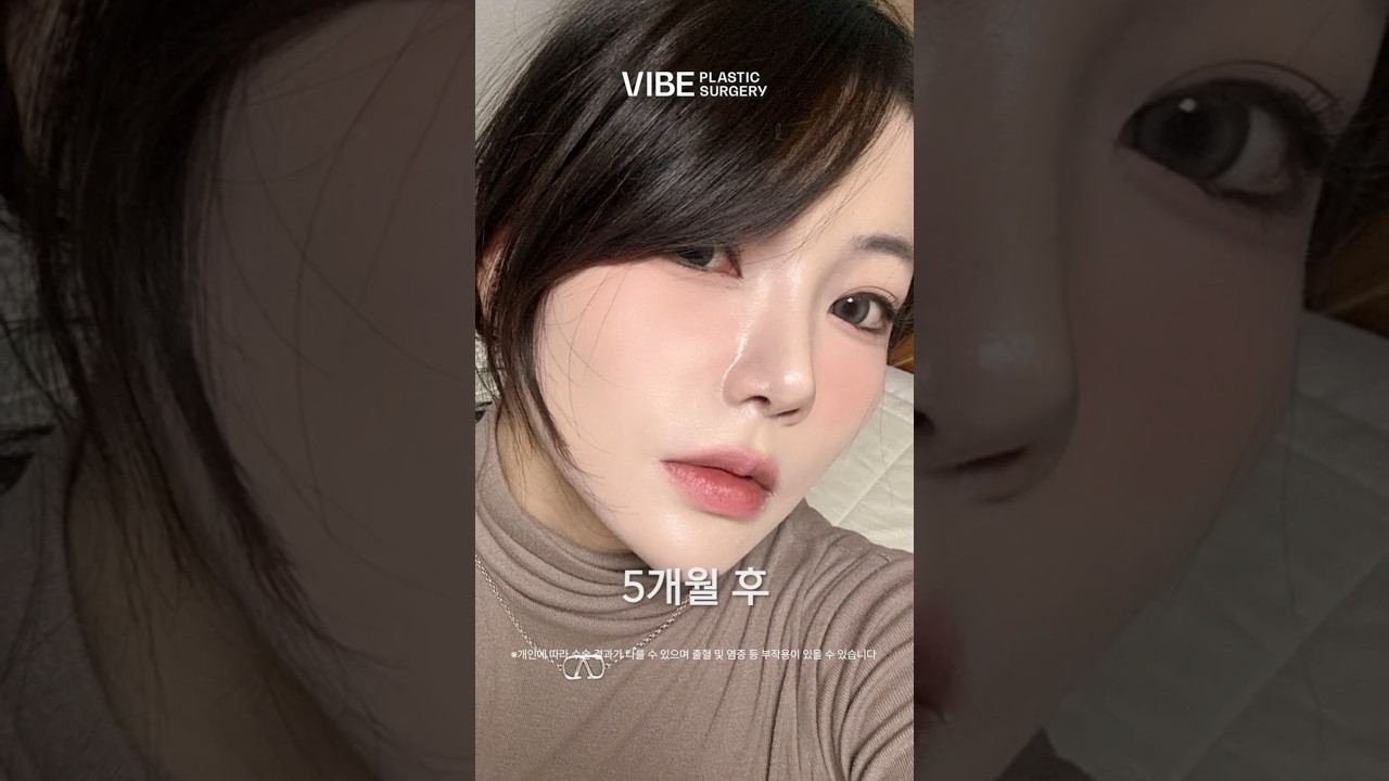 눈코성형 희망편✨ 답답한 눈, 들창코가 고민이라면?｜이마거상, 쌍꺼풀, 코재수술