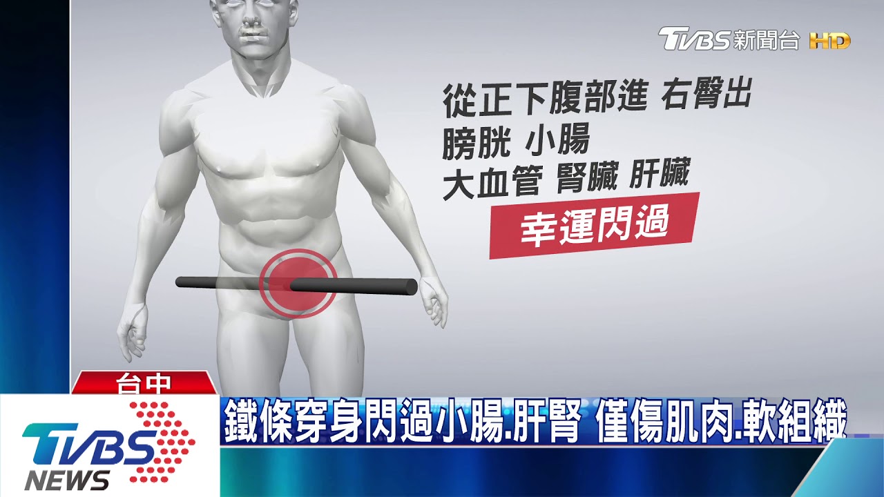 中龍鋼鐵外包工人 遭80cm鐵條插肚穿臀