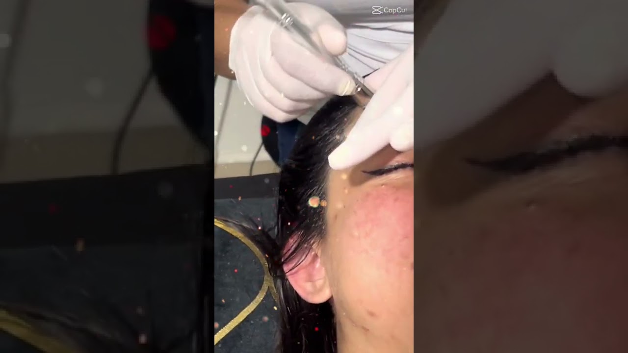 Watch Tratamiento Facial Microdermoabrasión con Punta Diamante. Now Tratamiento Facial Microdermoabrasión con Punta Diamante.