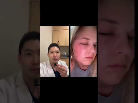 Pimple pop at home turned bad!