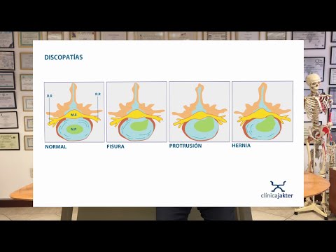 Dolor de espalda por Fisura o Protrusión Discal - Dr. Isaac Jakter