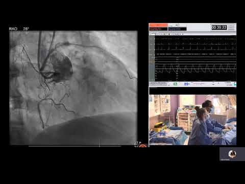Antegrade dissection re-entry (ADR) technique to treat a calcified RCA chronic total occlusion