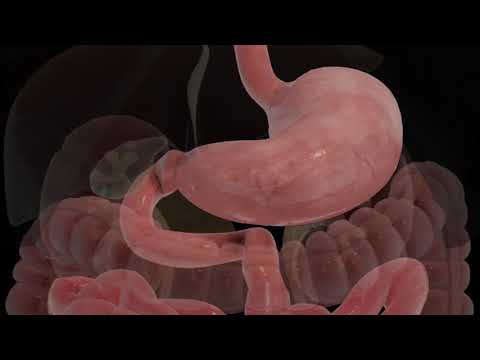 Single Anastomosis Duodenal-Ileal Bypass with Sleeve Gastronomy (SADI-S)