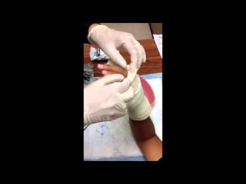 How To Apply An Ulnar Gutter Cast