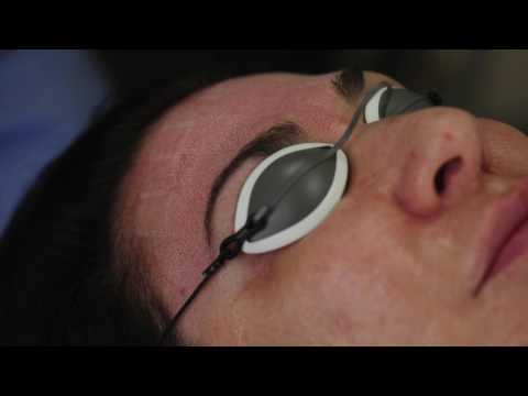 Fractional Full Face Laser Resurfacing