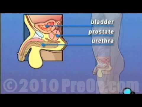  Transurethral Resection Prostate