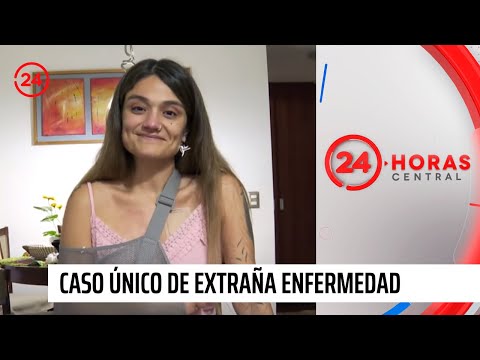 Mujer es caso único en Chile de extraña enfermedad: necesita $50 millones para operarse | 24 Horas