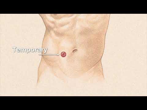 Watch video titled Ileostomy and J Pouch Surgery on YouTube