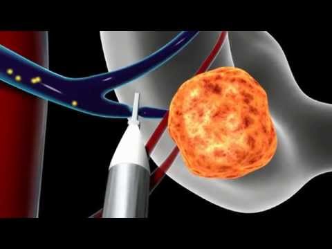 Overview of Minimally Invasive Parathyroid Surgery | CENTER for Advanced Parathyroid Surgery