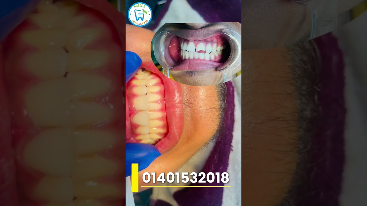 ভাঙ্গা দাঁতের সমাধান মাত্র ১ ঘন্টায় - ভিডিও পর্যালোচনা