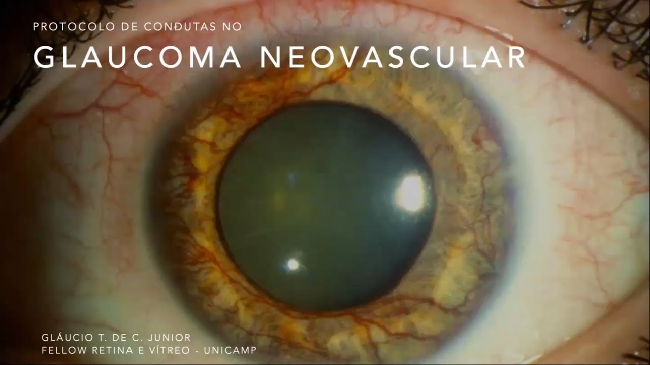 Retina e Vítreo (12/09/2024) - Protocolo de Condutas no Glaucoma Neovascular