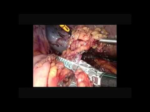 Operacja tętniaków tętnicy śledzionowej - protezowanie i splenektomia