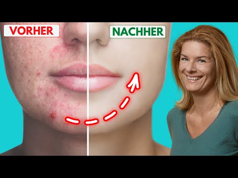 Dieses Hausmittel löst Pickel sofort (hat jeder zuhause) 🍅✨