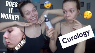 My Honest &amp; In Depth 2 MONTH review of CUROLOGY! | Acne Skin Care Routine