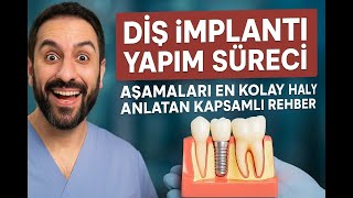 Zirkonyum Diş Kaplamada Doğal Gülüş Sırrını Açığa Çıkaran Etkileyici Rehber