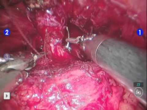 Reconstruction Of The Sphincter After Robot-Assisted Radical Prostatectomy