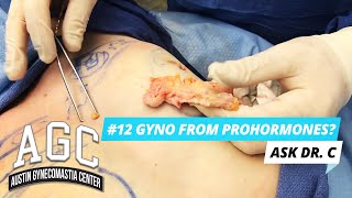 How Do You Treat Gynecomastia Caused By Steroids Or Prohormones? Ask Dr. C - Episode 12