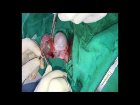Tracheal papillomatosis treatment