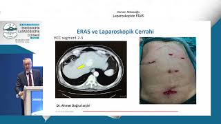 Laparoskopik Cerrahide ERAS / Osman Abbasoğlu