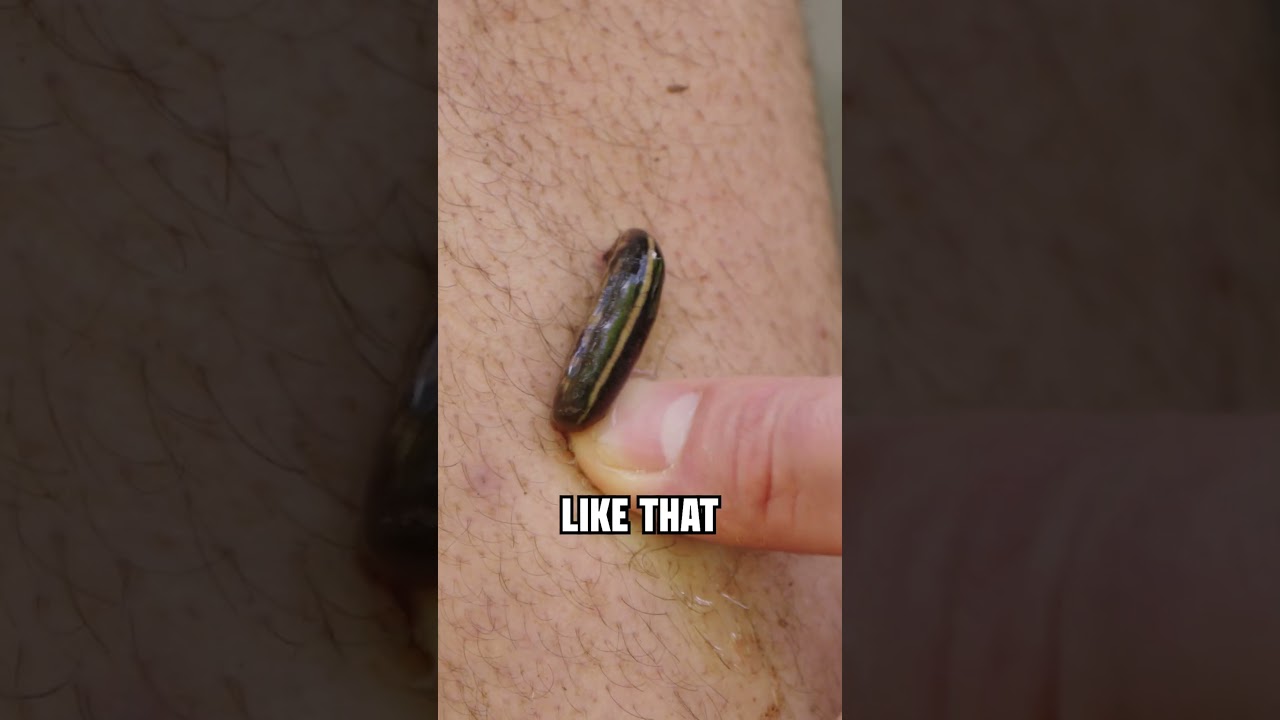 How to REMOVE A LEECH from your skin!