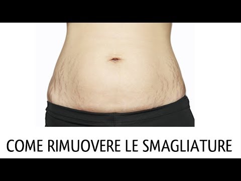 Mal di schiena nel diabete Displasia dellanca nei bambini di gesso