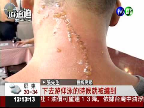 外木山泳賽前夕 驚傳水母螫人!