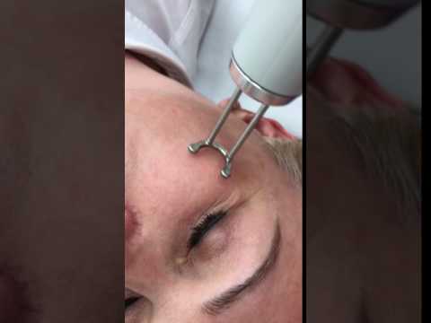 laserowe usuwanie przebarwień wrocław discovery pico kaniowscy dermapuls