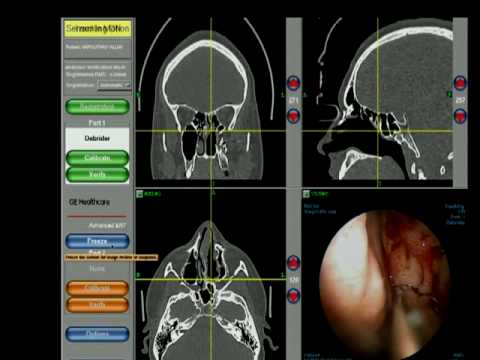 Articolazioni fumatori Come determinare che si ha lernia intervertebrale