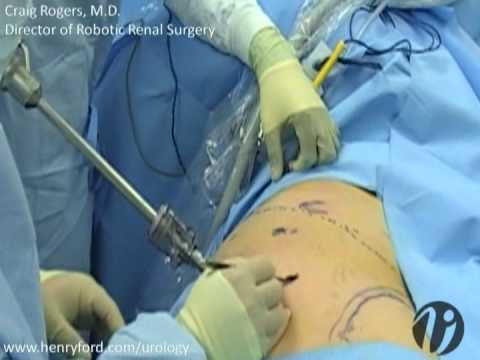 Robotic Partial Nephrectomy - Step 2: Port Templates and Trocar Placement